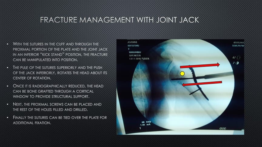 Joint Jack 3